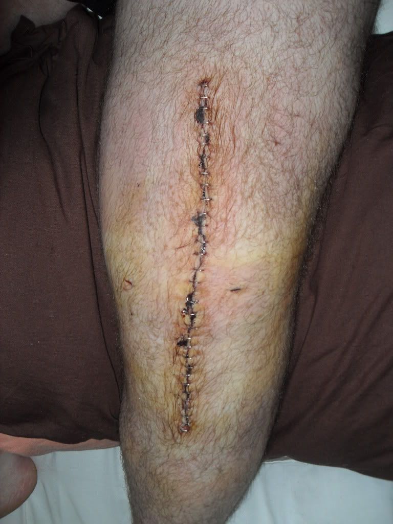 Vasectomy Scar